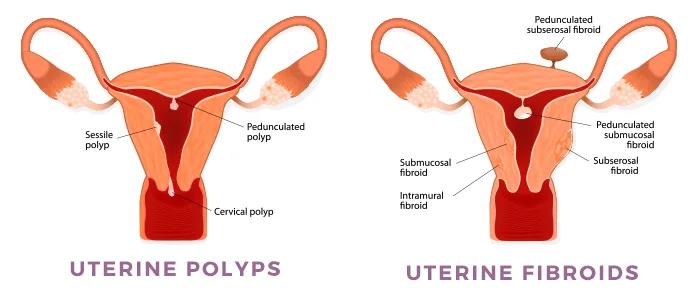 Uterine Fibroids & Polyps Treatment India 2026