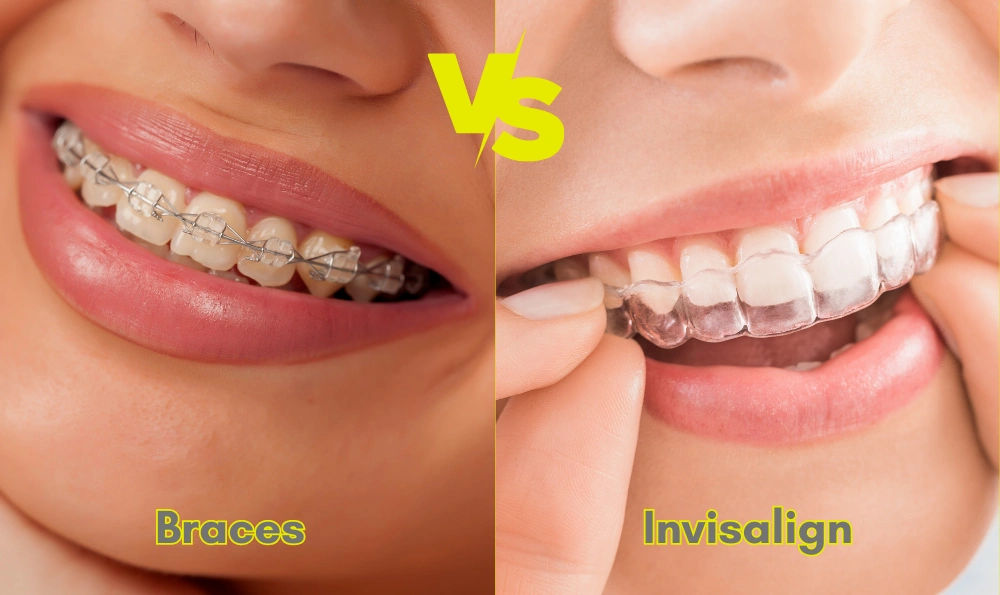 Invisalign/Clear Aligners