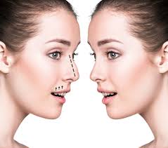 Rhinoplasty (Nose Reshaping)