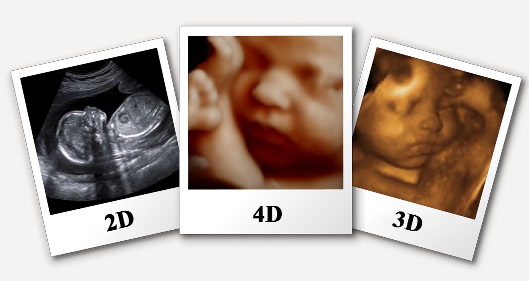 4D Ultrasound