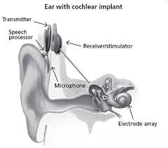 Cochlear Implant Surgery