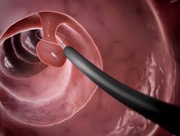 Colonoscopy with Polypectomy