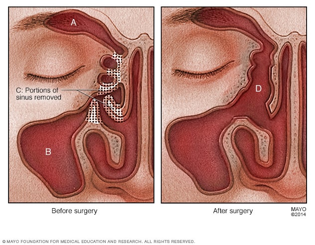 Endoscopic Sinus Surgery (FESS)
