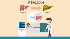 Liver Fibroscan