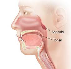 Tonsillectomy & Adenoidectomy